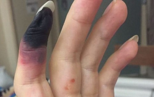 细菌感染太可怕!美女子感染后被截六根手指两根脚趾